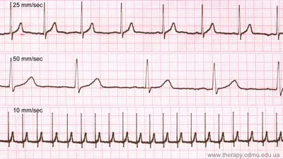 Нормальная кардиограмма сердца фото фото