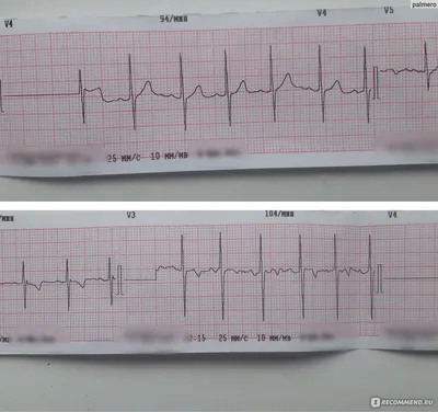 Электрокардиография (ЭКГ) - «ЭКГ ребенку - что покажет, а за каким  заключением надо идти на УЗИ сердца. Синусная аритмия, брадиаритмия  (брадикардия), тахикардия и т.д. - не приговор » | отзывы