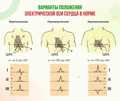 Что значит ЭОС, отклонение влево, вправо, вертикальная, горизонтальная.