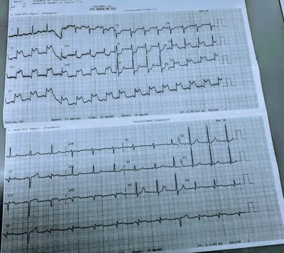 Может при инфаркте быть нормальное ЭКГ? часть 2 | Советы израильского  кардиолога | Дзен