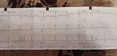 Электрокардиография (ЭКГ) - «Оказывается ЭКГ не такая уж и информативная  диагностика проблем с сердцем, но ей по прежнему верит и скорая, и  кардиологи. Но сделать ЭКГ всегда необходимо. » | отзывы