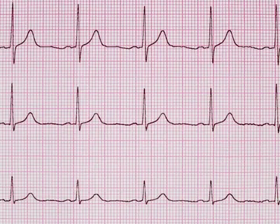 Кардиограмма (ЭКГ) в Киеве - цена электрокардиографии с расшифровкой |  IMPULS24/7