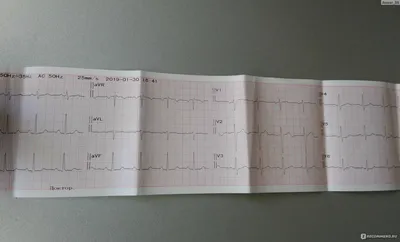 EKG Algoritmy | PDF