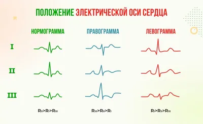 Что значит ЭОС, отклонение влево, вправо, вертикальная, горизонтальная.