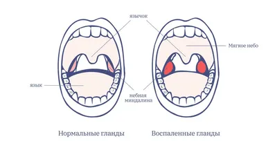 У ребенка большие гланды. Это проблема? | Купрум | Дзен