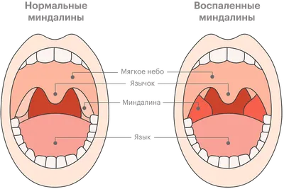 Ответы Mail.ru: Нормальные ли у меня миндалины?