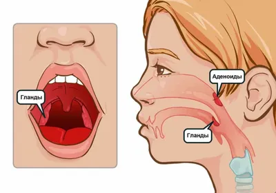 Ангина - причины появления, симптомы заболевания, диагностика и способы  лечения