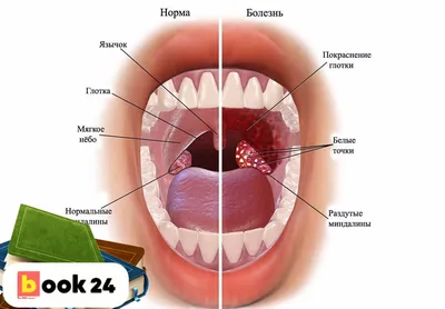 Прошу не брезгливых, посмотрите на миндалины ребёнка! - ответы с 30 по 60 -  Советчица