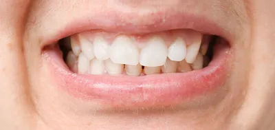 Нормальный прикус: как определить правильное расположение зубов при  идеальном прикусе и аномалии при неправильном