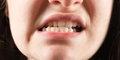 Неправильный прикус: причины, последствия, способы исправления | Центр  стоматологии «Ваш Стоматолог»