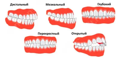 Неправильный прикус зубов виды и способы лечения в Минске, «Брекетлаб»