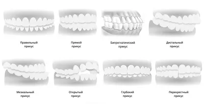 Правильный прикус и его влияние на здоровье зубов