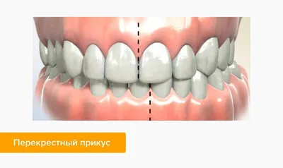 Чем неправильный прикус прозит здоровью зубов - Стоматология \"Алекс\" в  Жуковском