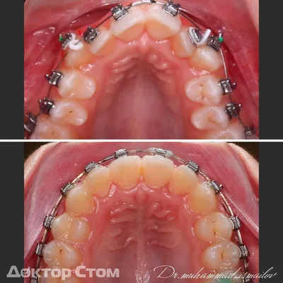 Правильный прикус у человека: фото зубов | Dental Art