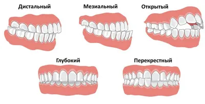 Как выглядит правильный прикус. Как его определить?