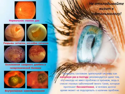 Рак глаза: виды, симптомы и лечение - 11 августа, 2023 Статьи «Кубань 24»