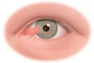 Новообразования глаз - причины, симптомы, диагностика, лечение и  профилактика