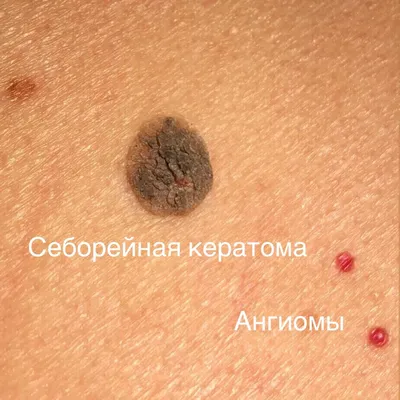 Удаление доброкачественных новообразований кожи - цена в Минске