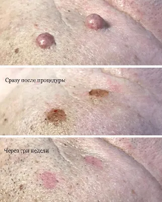 Рак кожи - симптомы и признаки | Центр лечения онкологии СМ-Клиники