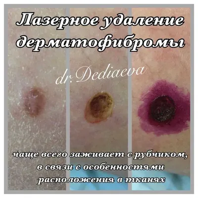 Удаление доброкачественных новообразований кожи - Клиника доктора Есиповой
