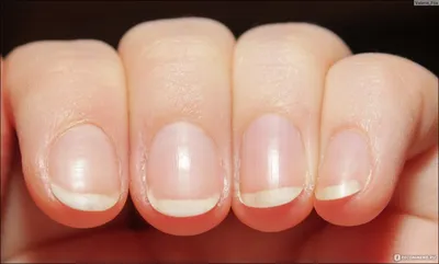 Эти опасные заболевания можно выявить по изменениям ногтей