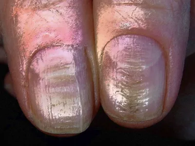 Лейконихия – что означают белые пятна на ногтях и как их лечить, симптомы,  причины появления и профилактика