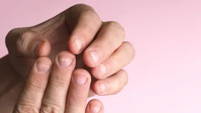 О чем говорят белые пятна на ногтях?