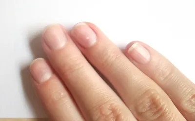 Погадать на руке: заболевания, о которых вам расскажут собственные ногти