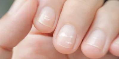 ACI Nail School - О чём говорят ногти?🤨 Да, ногтевые пластины могут  рассказать о многом ☝🏻 ⠀ Что мы знаем о поперечных бороздах? 😯 Часто  встречаются такие нарушения после механических воздействий (