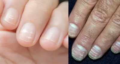 О каких проблемах организма говорят ваши ногти: 5 симптомов нездоровья