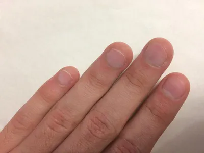 Ребёнок грызёт ногти – причина