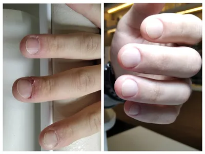 Как восстановить обгрызенные ногти: простые способы + 5 народных способов  восстановления -