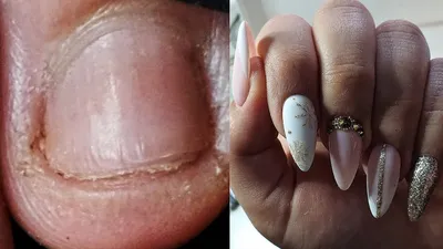 Bitten Nails Transformation | Nothing Holds On the Nails! - YouTube