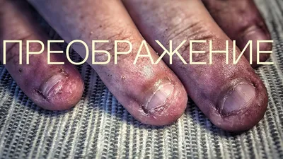 ногти грызуна. преображение. обкусанные ногти/часть 1 - YouTube | Acrylic  nail shapes, Nail shapes, Nails