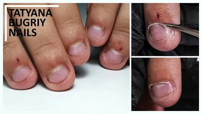 Наращивание проблемных ногтей.... - Beauty Center ЭЛИНА | Facebook
