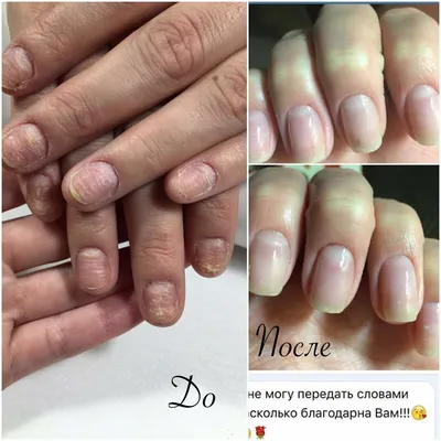 💅Короткие, обкусанные ногти – недостаток, который портит жизнь клиентам  независимо от возраста. Грызть ногти - это не только вредная и… | Instagram