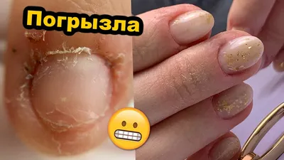 Как правильно стричь ногти? | Московская Клиника Подологии