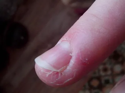 Почему трескается кожа на пальцах рук около ногтей?
