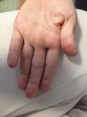 Ребенок 7,5 лет, после гриппа и антибиотиков на пальцах рук облезла вся кожа,  болит. На что это похоже? - Я happy MAMA