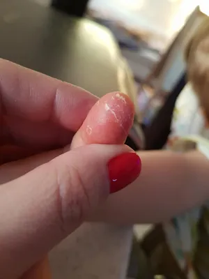 У ребенка, 2.2 года внезапно облезла кожа на пальце. Что это может быть? -  Я happy MAMA