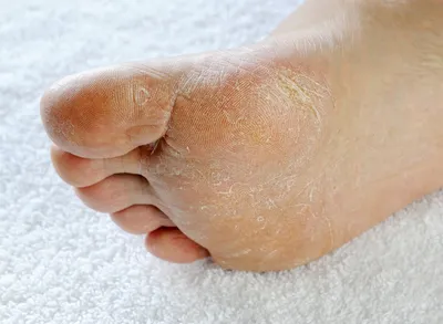 Шелушится кожа на ступнях ног – что делать, как лечить