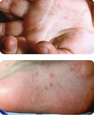 У ребёнка облазит кожа на ногах и руках. | Консультация дерматолога в  Минске на DOKTORA.BY - ВРАЧИ БЕЛАРУСИ