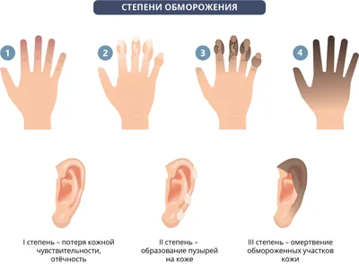 Третьей Степени Обморожение Для Пальцев Ног — стоковые фотографии и другие  картинки Отмореженный - Отмореженный, XXI век, Боль - iStock