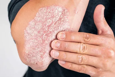 Кожа псориаза Псориаз аутоиммунная болезнь которая влияет на воспаление  кожи причины кожи красное и чешуистое Eczema Стоковое Фото - изображение  насчитывающей медицинско, указывать: 111841492