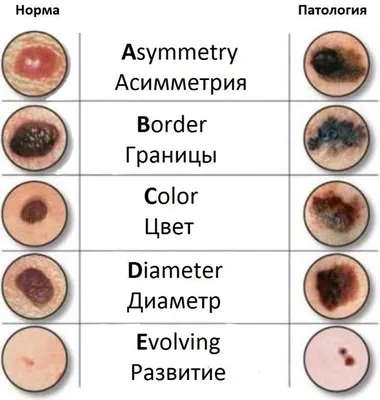 Меланома кожи: как выглядит, симптомы, причины, диагностика, лечение