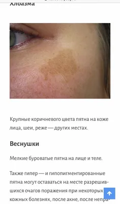 Недостаток кожи Аллергия на кожу Болезнь Уртикарии Красные пятна на коже  Стоковое Фото - изображение насчитывающей здоровье, мой: 158917846