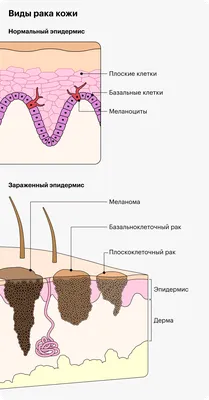 Стало известно, какие образования на коже могут быть предвестниками рака -  Газета.Ru | Новости