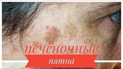Недостаток кожи Аллергия на кожу Болезнь Уртикарии Красные пятна на коже  Стоковое Изображение - изображение насчитывающей эпидемия, взорвать:  158915943