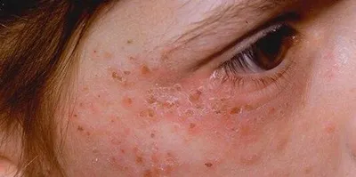 Красные пятна на коже – причины возникновения заболевания, какой врач  лечит, диагностика, профилактика и лечение