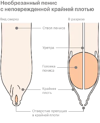 Фимоз